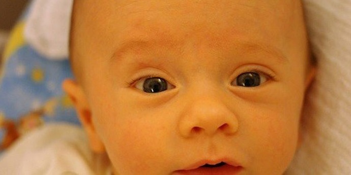 زردی صورت نوزاد - درمان زردی نوزاد