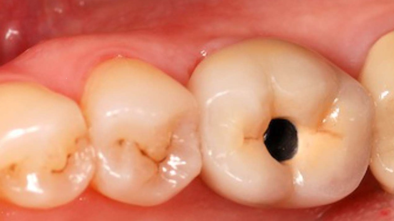 پوسیدگی دندان ها - جلوگیری از پوسیدگی دندان