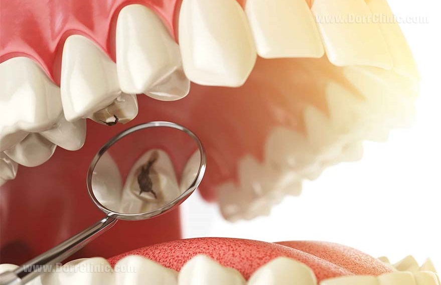 پر کردن دندان - جلوگیری از پوسیدگی دندان