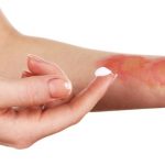 درمان خانگی سوختگی پوست