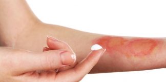 درمان خانگی سوختگی پوست