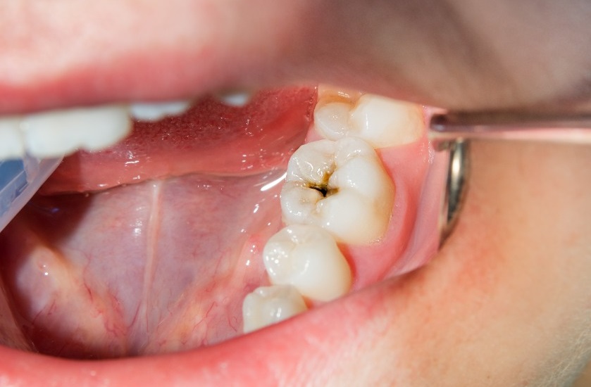 پوسیدگی دندان - جلوگیری از پوسیدگی دندان