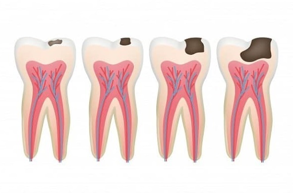 مراحل پوسیدگی دندان - جلوگیری از پوسیدگی دندان