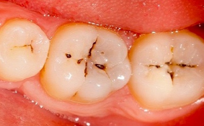 رفع پوسیدگی - جلوگیری از پوسیدگی دندان