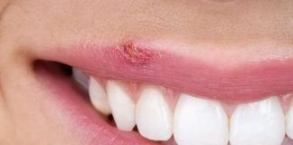 درمان خانگی تبخال