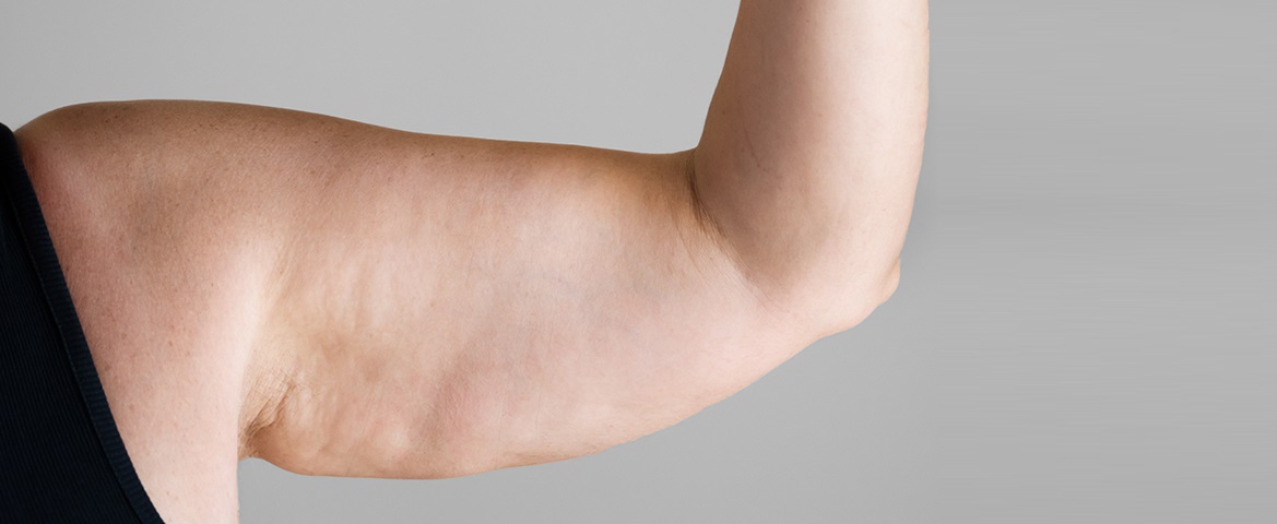 سلولیت بازو - درمان سلولیت