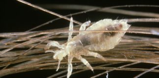 درمان خانگی شپش سر