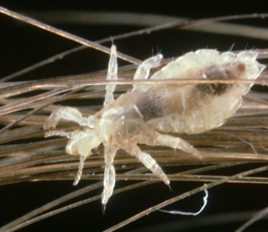 درمان خانگی شپش سر