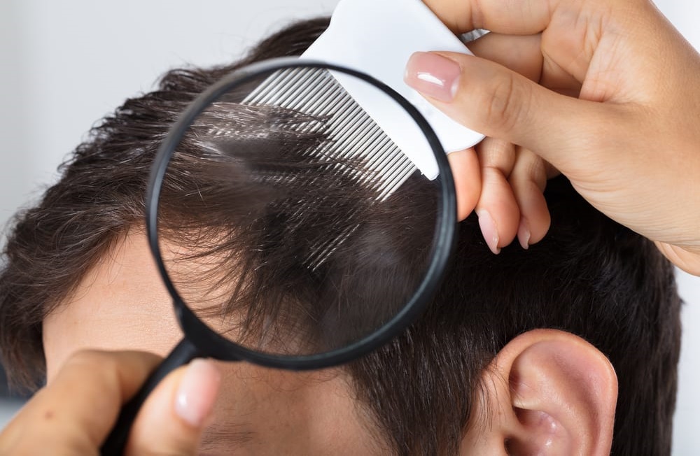 شانه زدن مو - درمان خانگی شپش سر