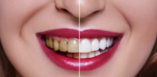 سفید کردن دندان