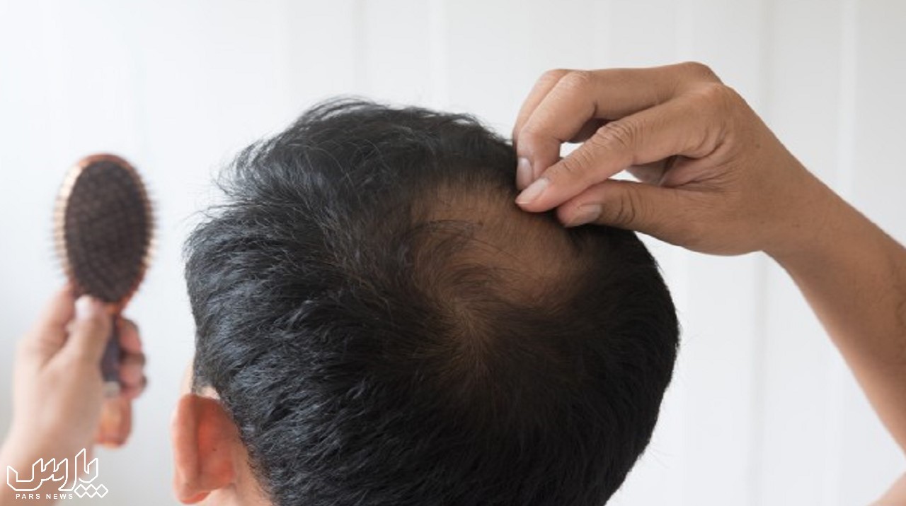 کم پشت شدن موی مردان - تقویت موهای نازک و کم پشت