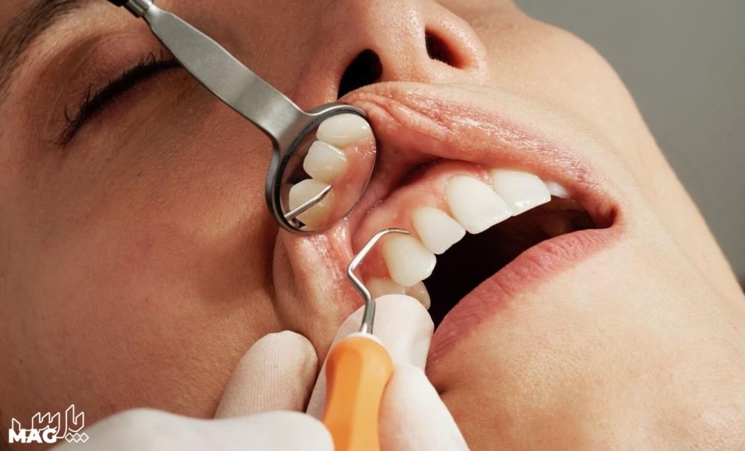 درمان عفونت ریشه دندان