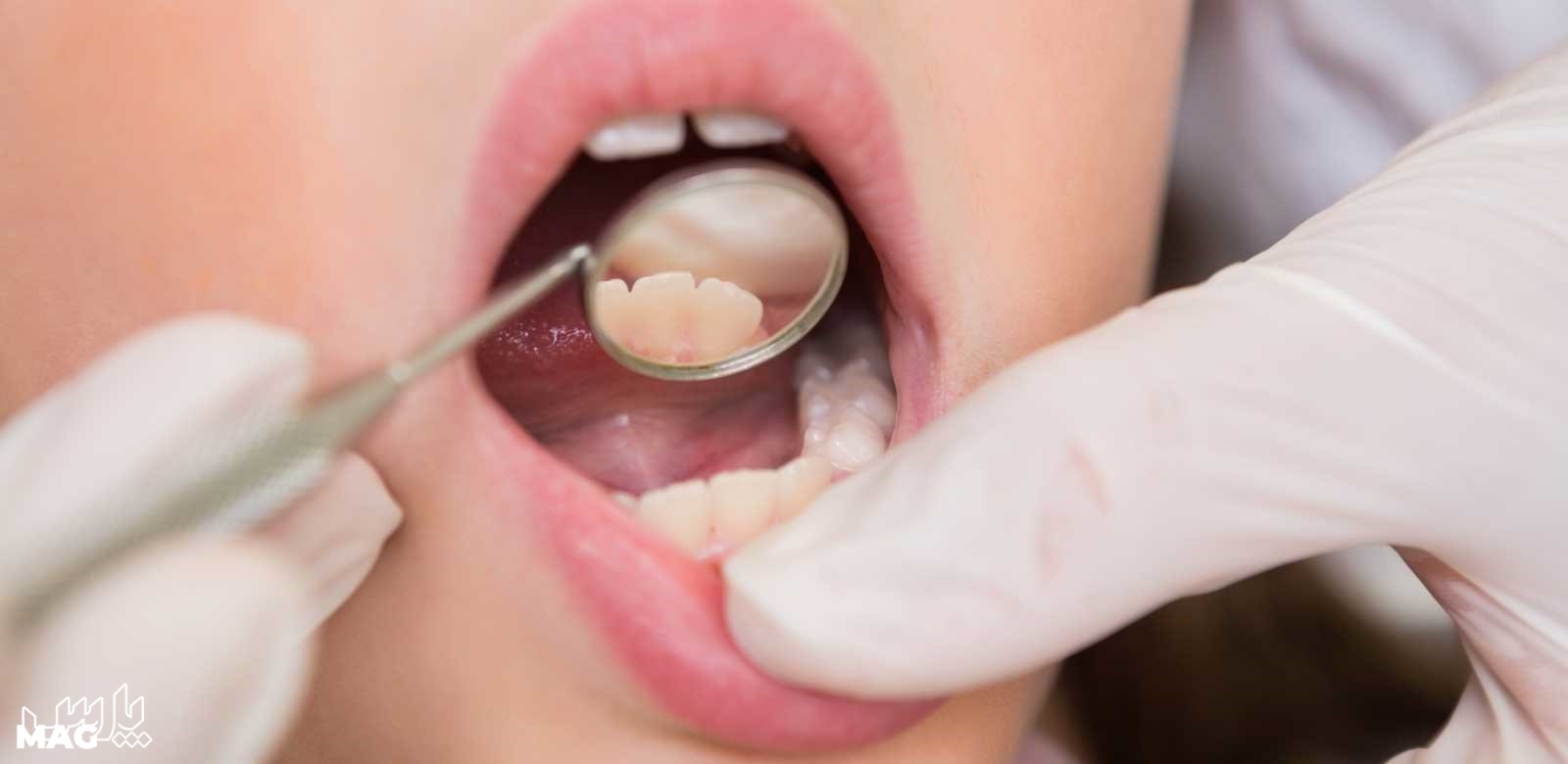 پرکردن دندان - درمان عفونت ریشه دندان