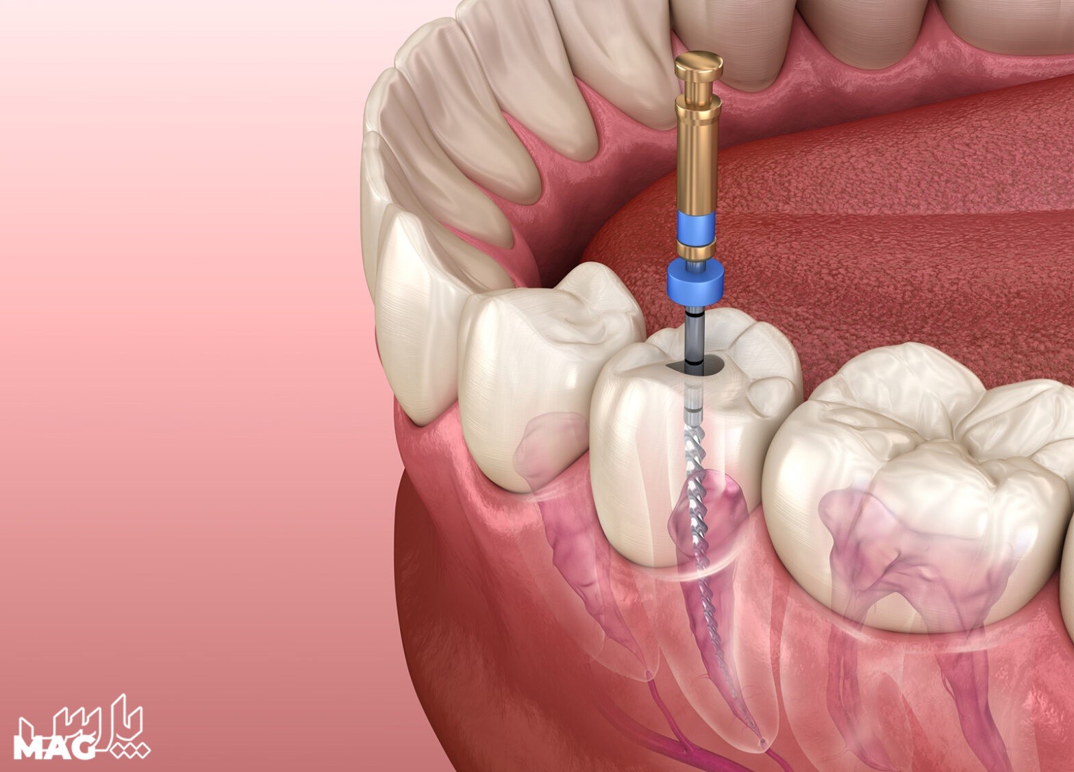 عصب کشی دندان - درمان عفونت ریشه دندان