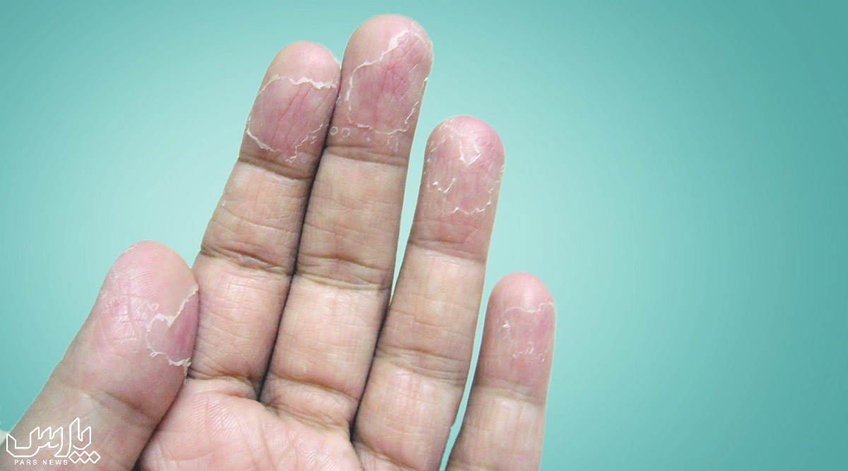 پوسته دادن نوک انگشتان - درمان ترک انگشتان دست