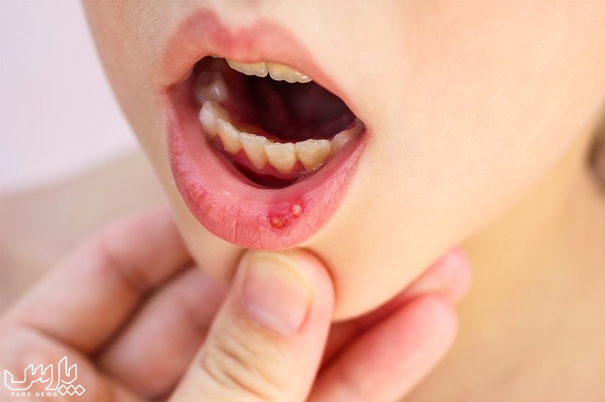 آفت دهان کودکان - درمان آفت دهان