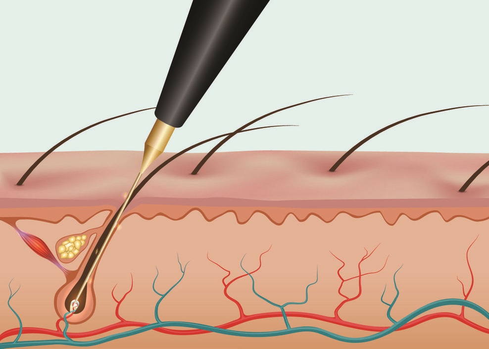 روش الکترولیز - الکترولیز موهای زائد