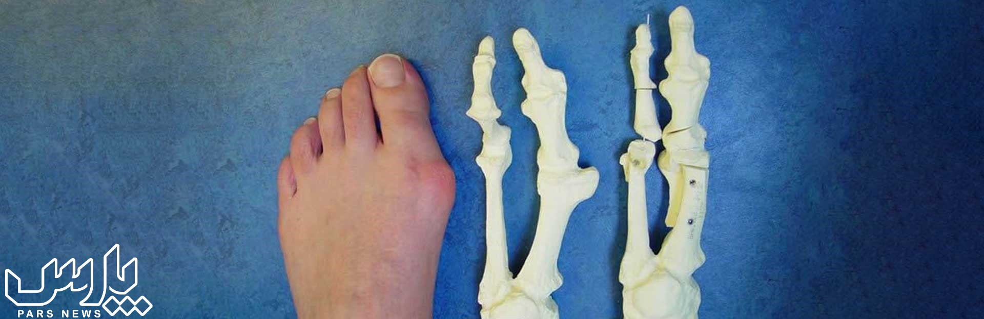 شگستگی استخوان - عوارض پوشیدن کفش تنگ