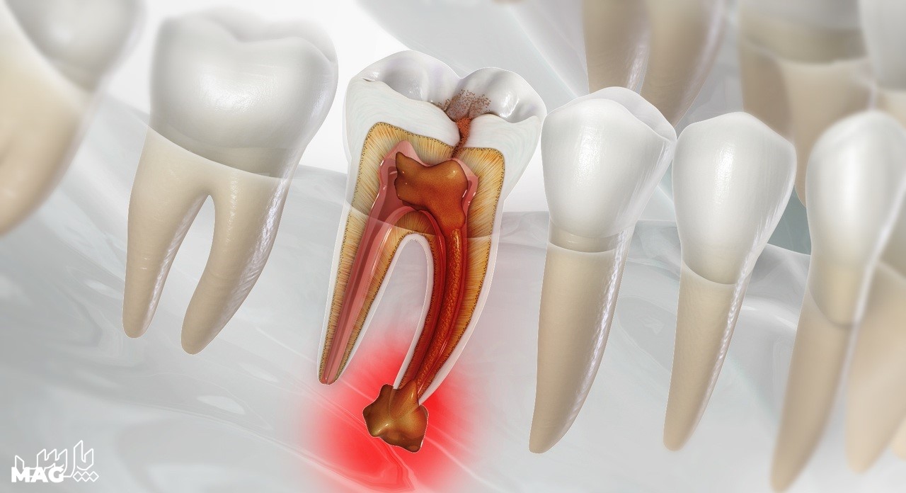 عفونت دندان - درمان عفونت ریشه دندان