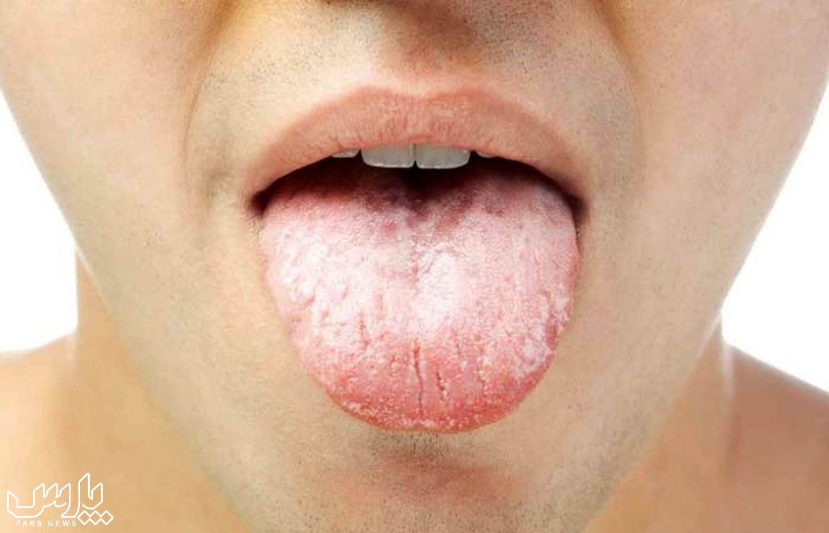 خشکی دهان - علت تلخی دهان در طول روز