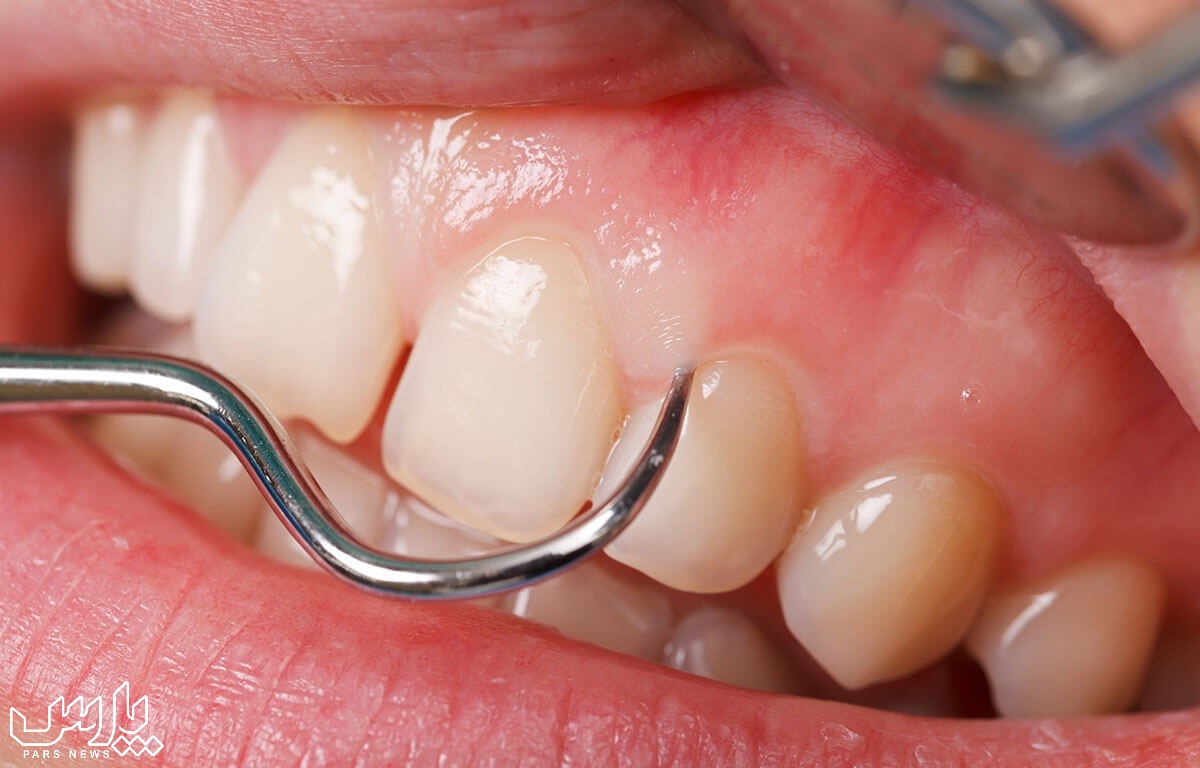 روش های جرمگیری دندان - جرم گیری دندان
