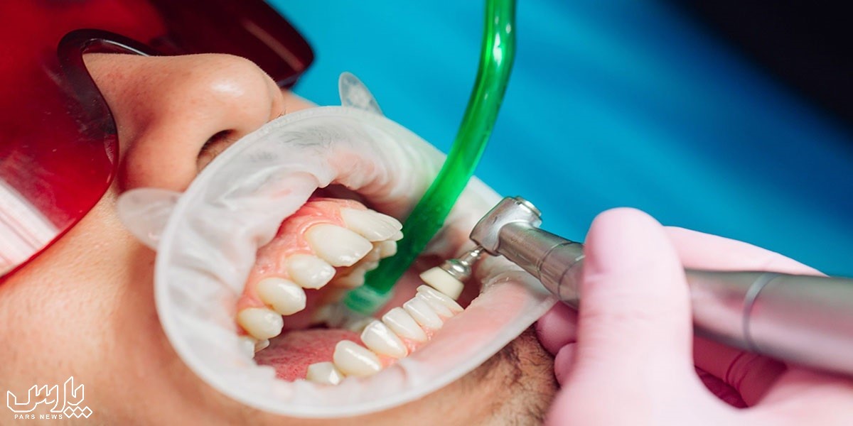 انواع جرم گیری دندان - جرم گیری دندان