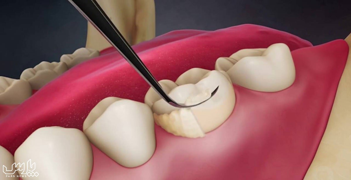 سلامت دندان - جرم گیری دندان