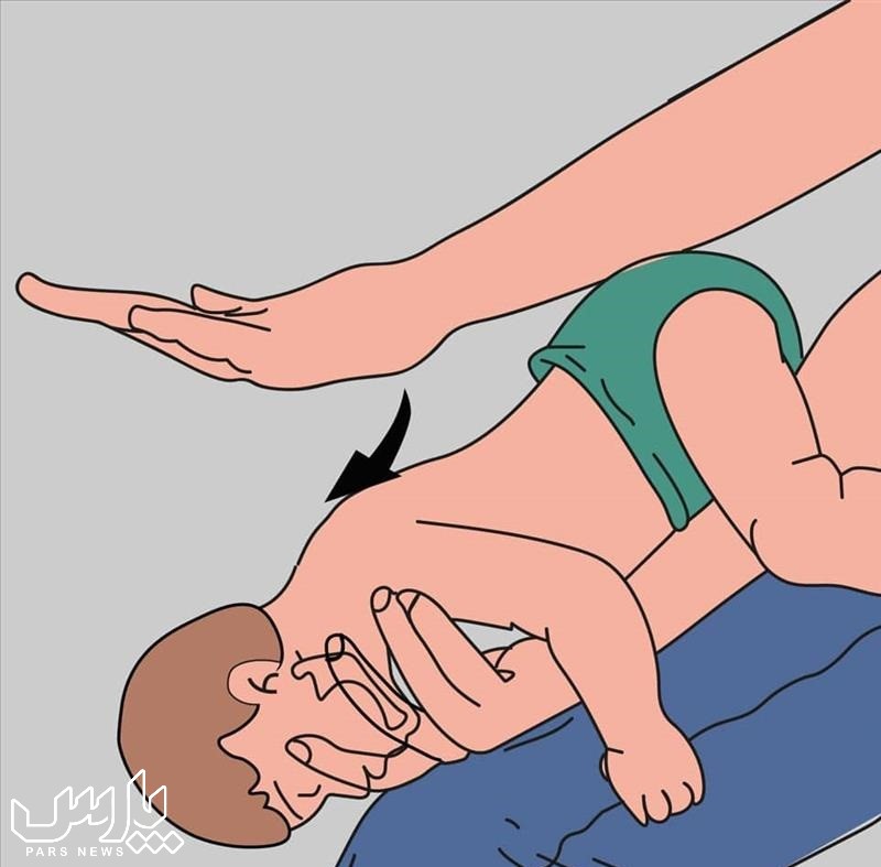 گرفتگی گلو نوزاد - کمک های اولیه هنگام خفگی