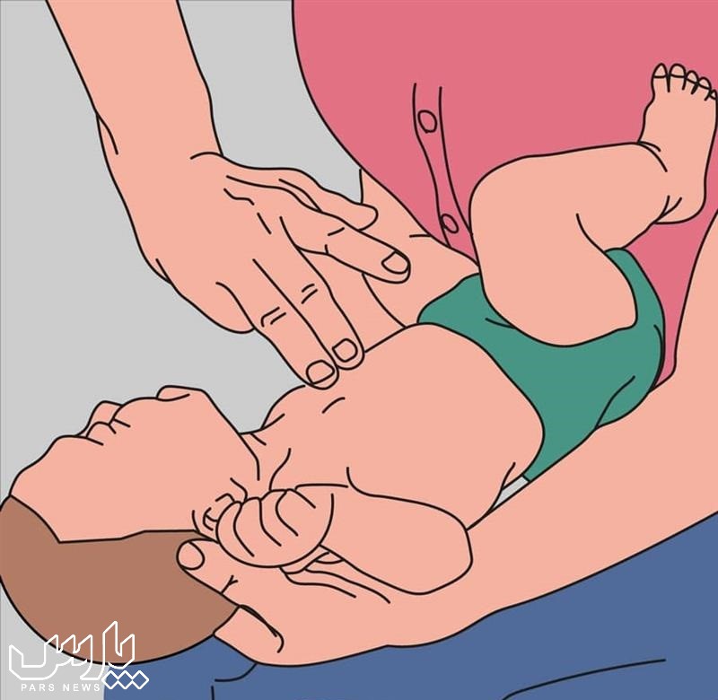 ماساژ قلبی نوزاد - کمک های اولیه هنگام خفگی