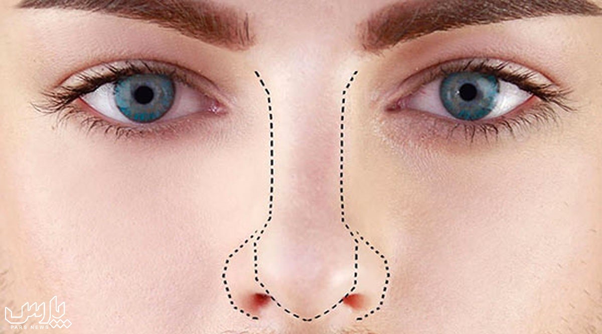 تیغه بینی منحرف - درمان انحراف بینی بدون جراحی