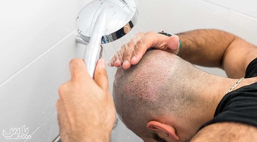 شستن موی کاشته - مراقبت های بعد کاشت مو