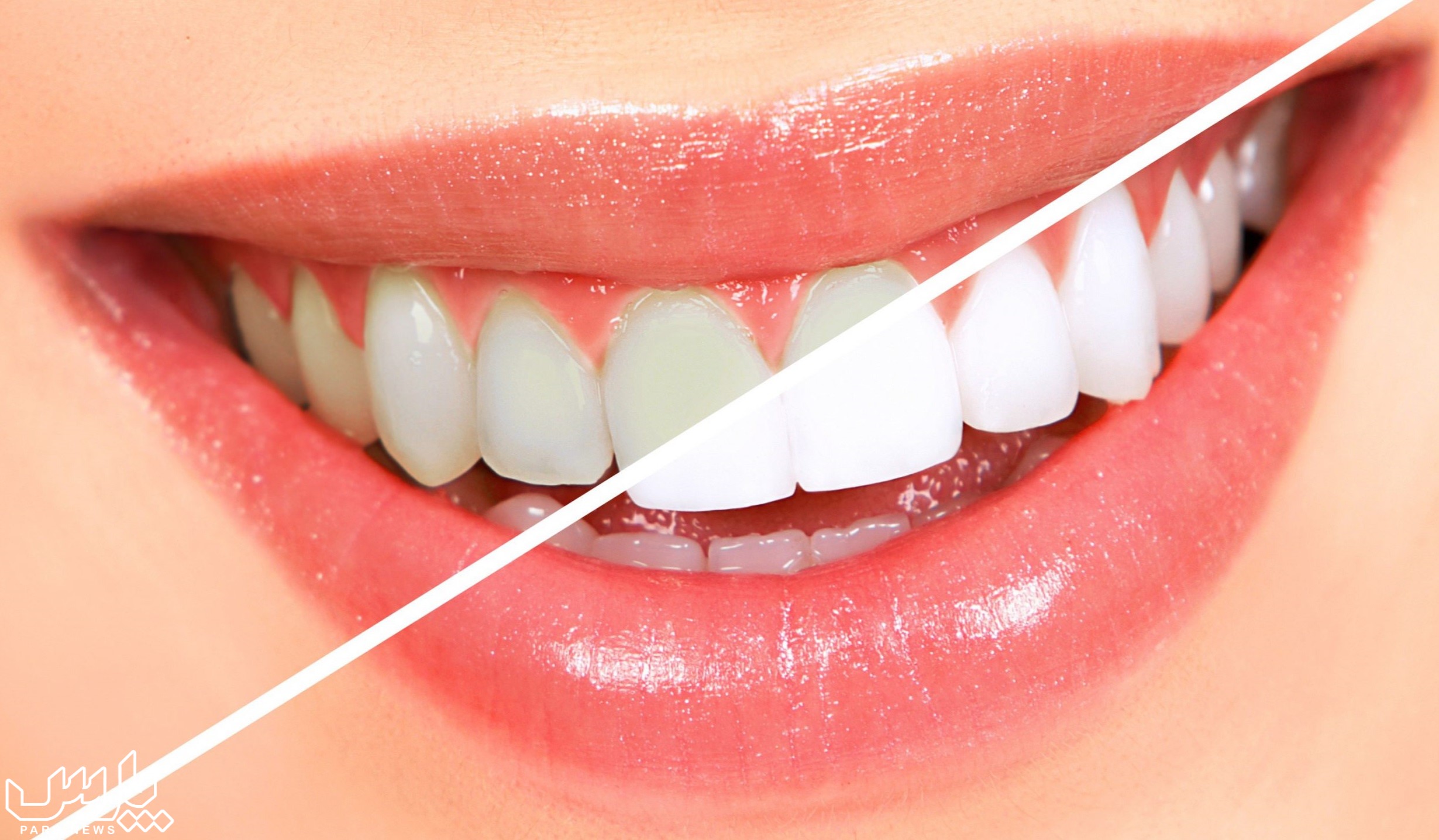 سفید کردن دندان - جرم گیری دندان