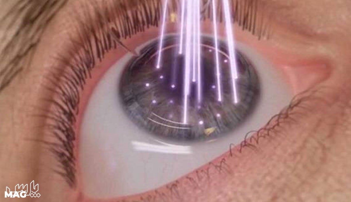 لیزیک - مراقبت های بعد از عمل لیزیک چشم