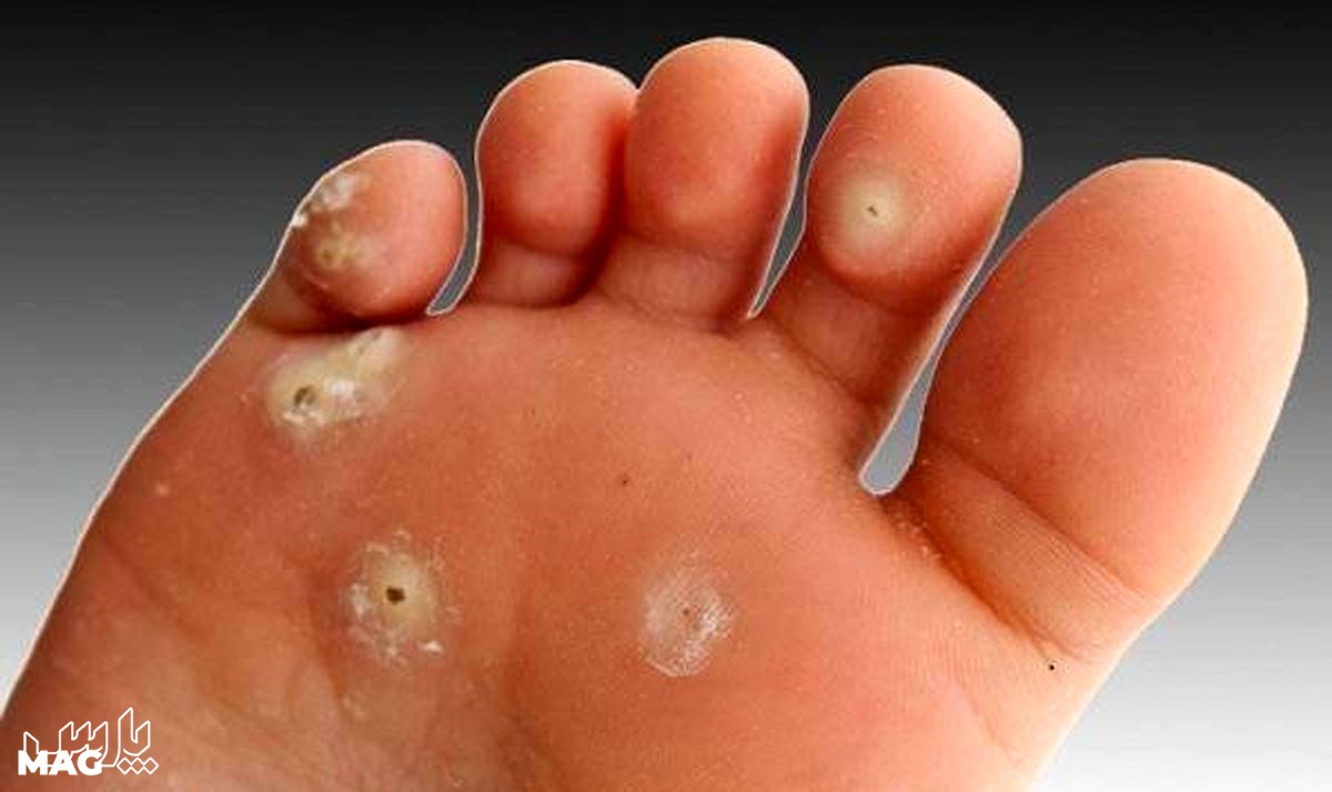 زگیل - درمان میخچه پا با گوجه فرنگی