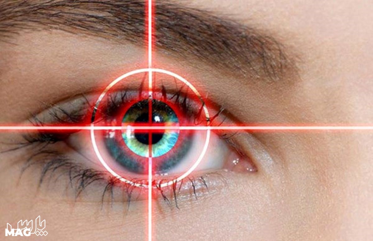 مراقبت از چشم - مراقبت های بعد از عمل لیزیک چشم