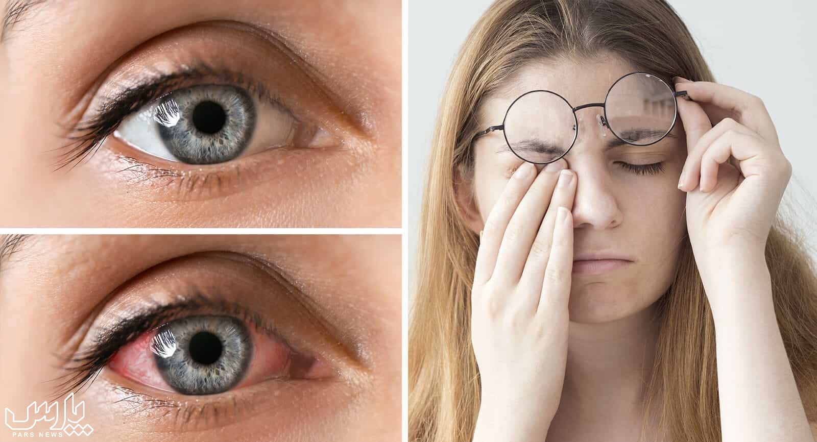 قرمزی چشم - درمان خانگی خستگی چشم