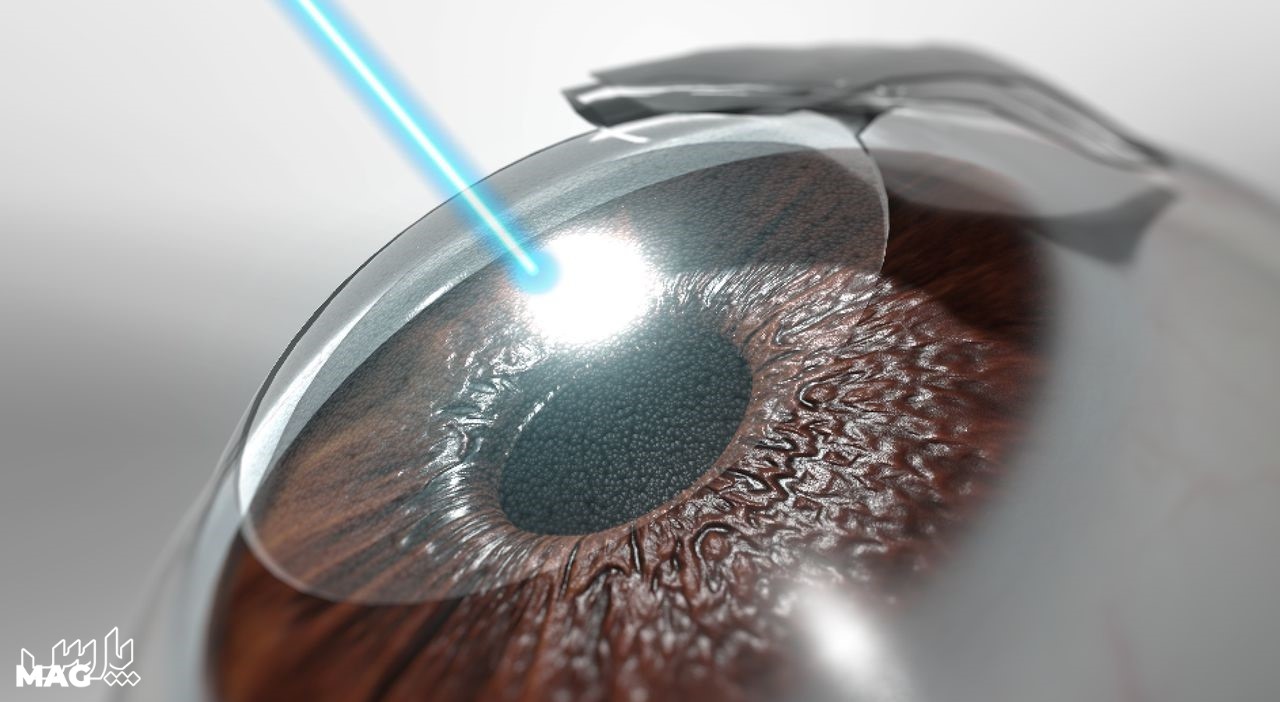 عمل لیزیک - مراقبت های بعد از عمل لیزیک چشم