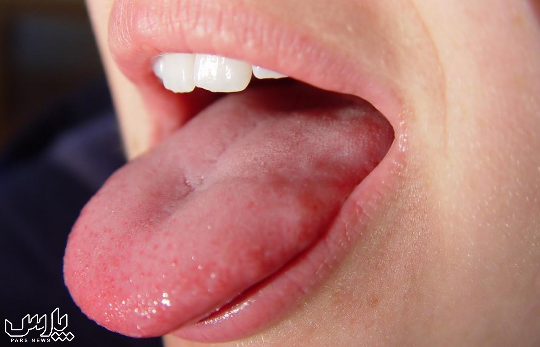 سوختن زبان - درمان سوختگی زبان با شکر