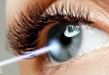 مراقبت های بعد از عمل لیزیک چشم