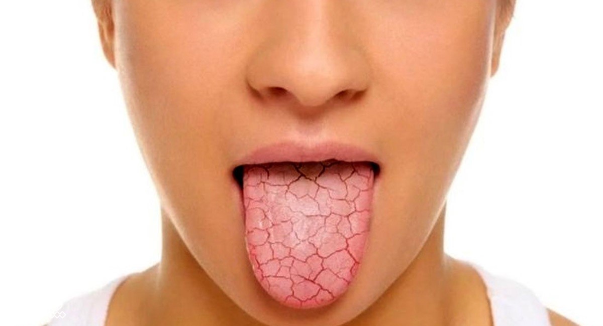 خشکی دهان - علت خشکی دهان و گلو در خواب