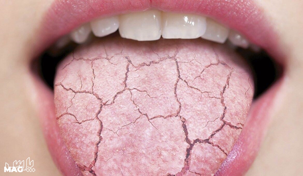 خشکی زبان - علت خشکی دهان و گلو در خواب