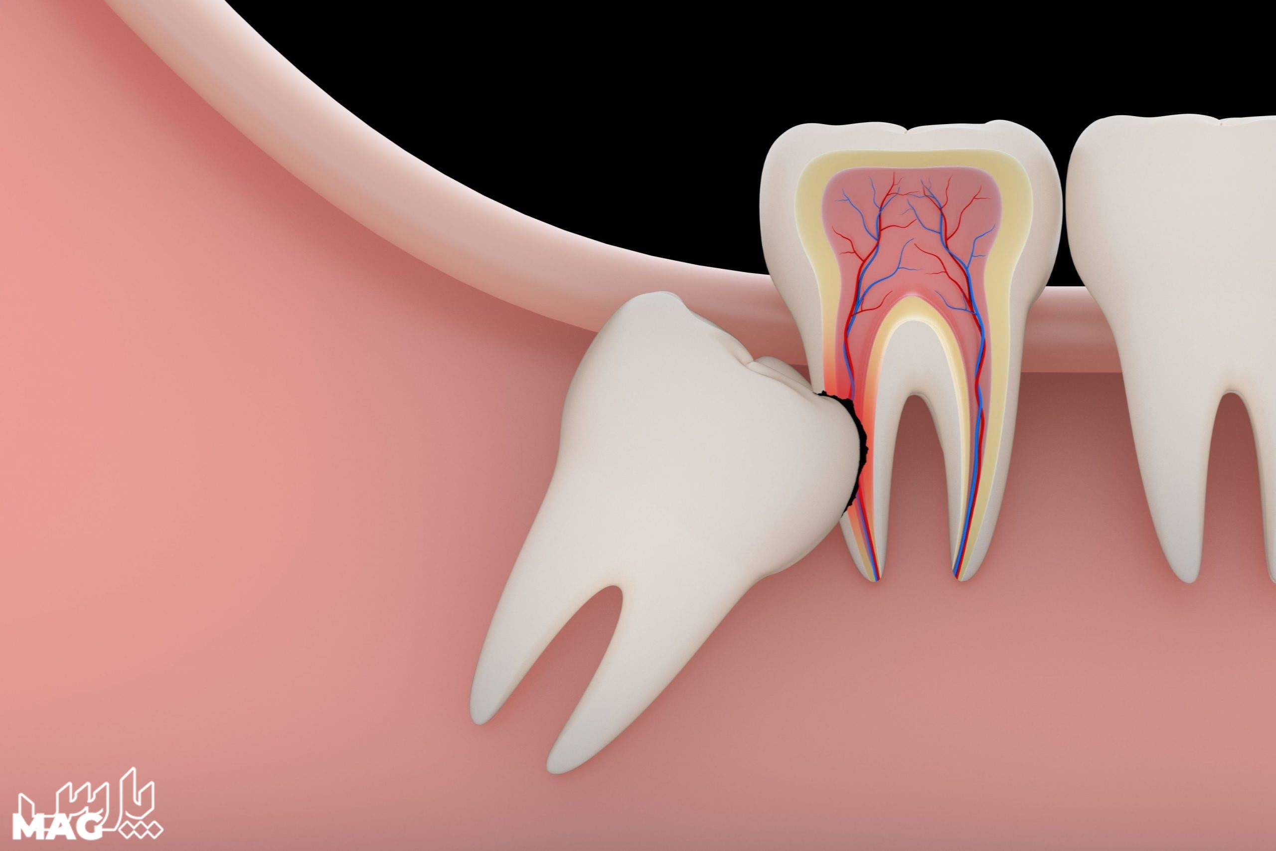 دندان عقل نهفته - مراقبت های بعد از کشیدن دندان عقل
