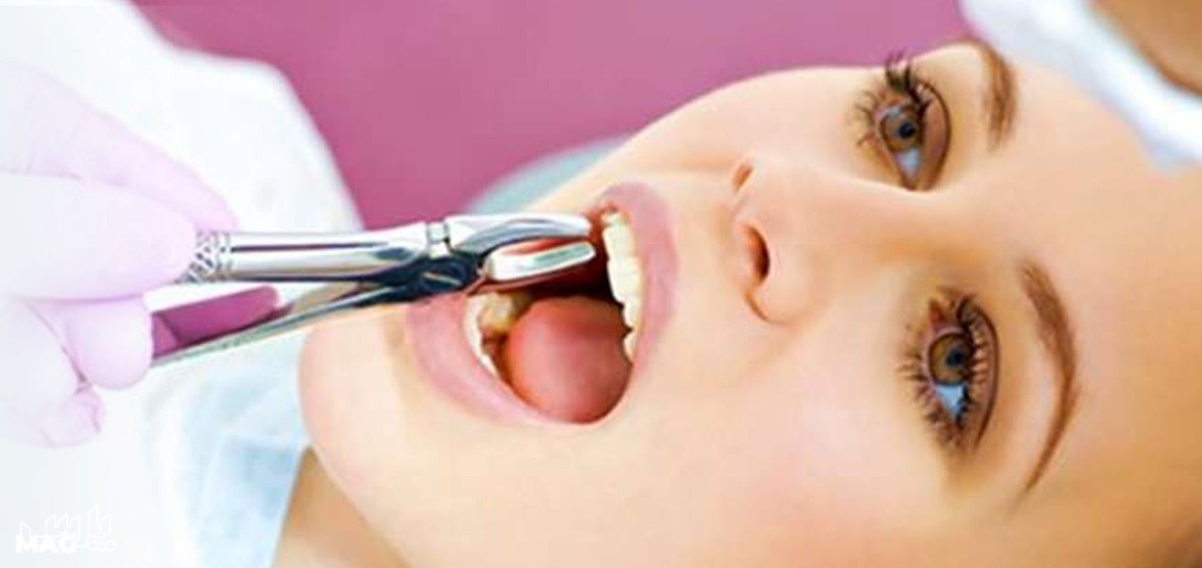 کشیدن دندان - مراقبت های بعد از کشیدن دندان عقل