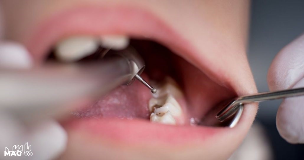 پر کردن دندان - مراقبت های بعد از کشیدن دندان عقل