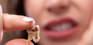 مراقبت های بعد از کشیدن دندان عقل