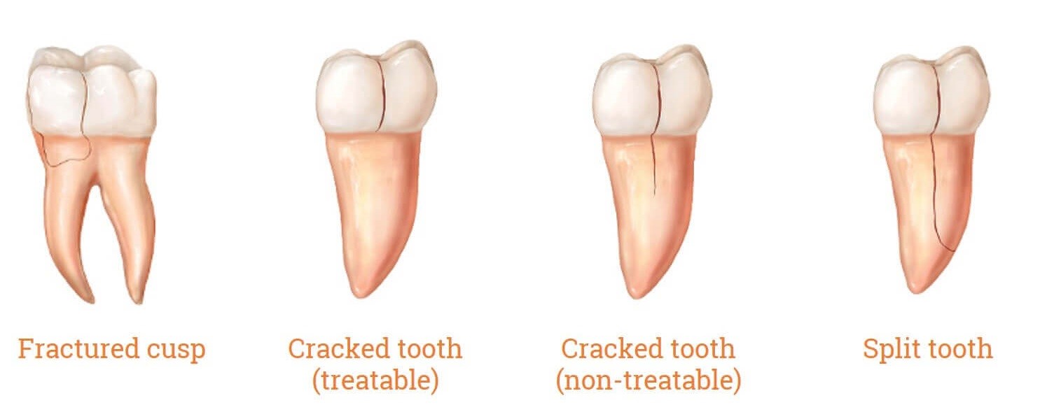 انواع شکستگی دندان - ترک خوردن دندان