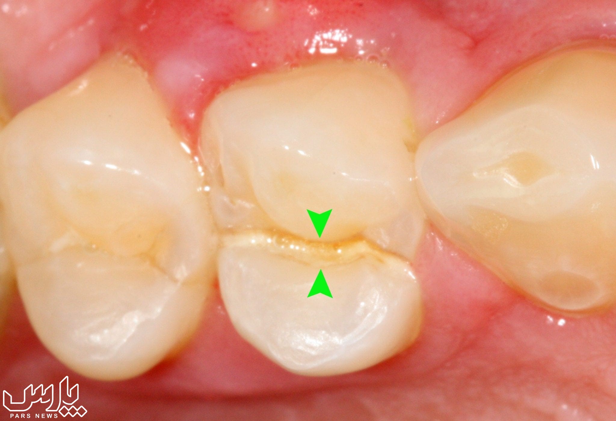 ترک دندان - ترک خوردن دندان