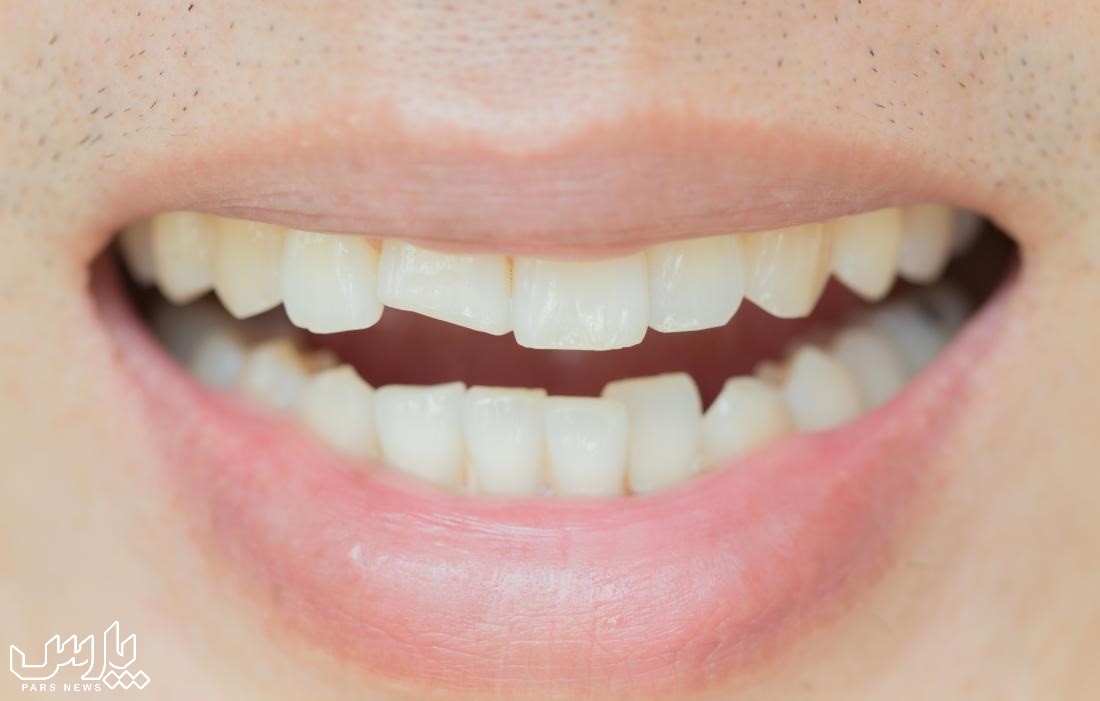 عصب کشی - ترک خوردن دندان