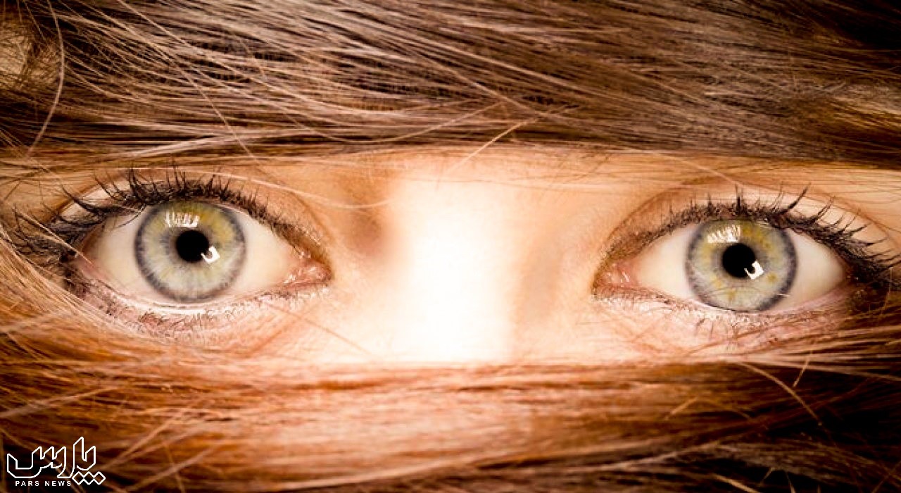 موی زائد صورت - پرمویی در زنان