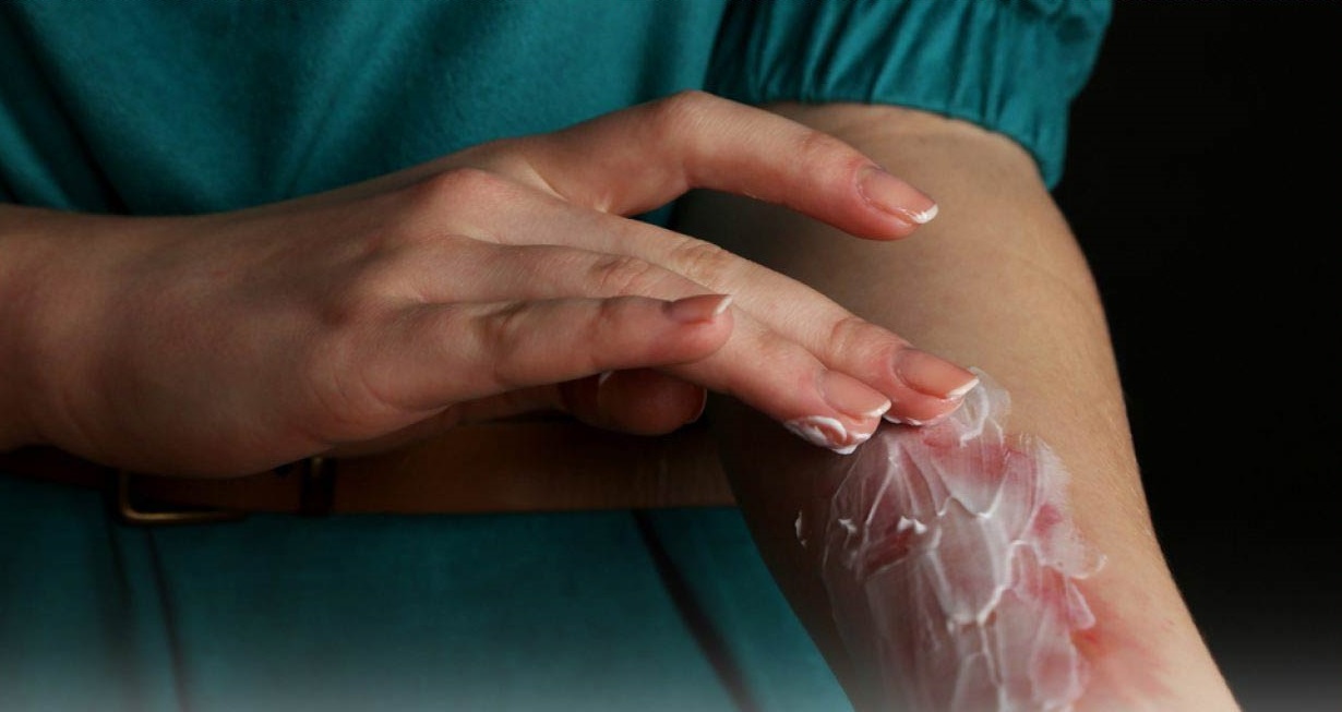 سوختگی پوست - درمان سوختگی در خانه